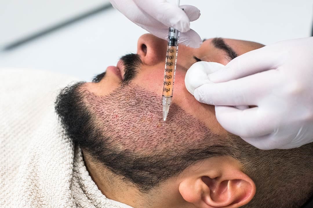 Une greffe de barbe nécessite en moyenne entre 2 000 et 3 000 follicules pileux pour couvrir les joues, le menton et la moustache.